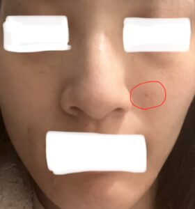 ホクロ